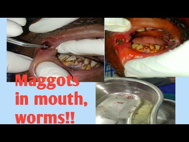 Maggots in mouth, poor oral hygiene and tabacco chewing, a case of Odisha