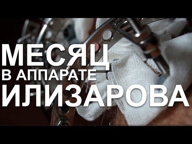 Месяц в аппарате Илизарова