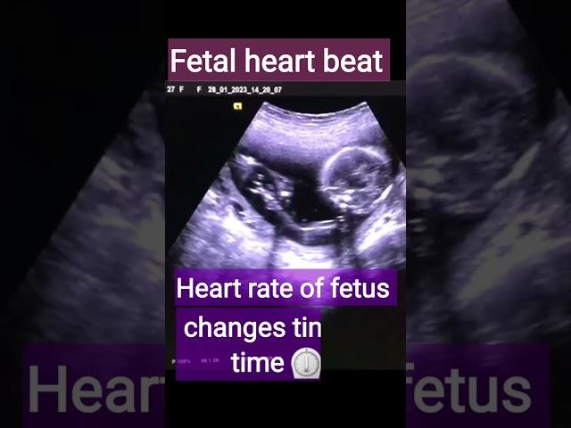 Fetal heart beat less than 140 is a baby boy /shorts