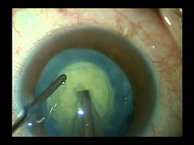 Surgery for a white cataract 6-13-11. Shannon Wong, MD.