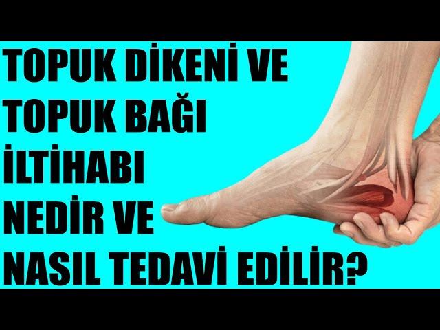 TOPUK DİKENİ VE TOPUK BAĞI İLTİHABI NEDİR VE NASIL TEDAVİ EDİLİR?