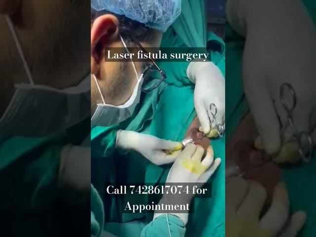 Laser fistula surgery I लेजर फिस्टुला ऑपरेशन I Fistula in ano