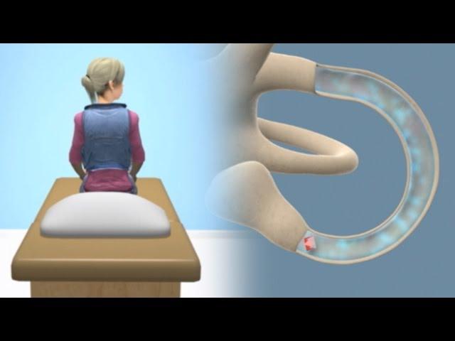 Epley Maneuver to Treat BPPV Vertigo