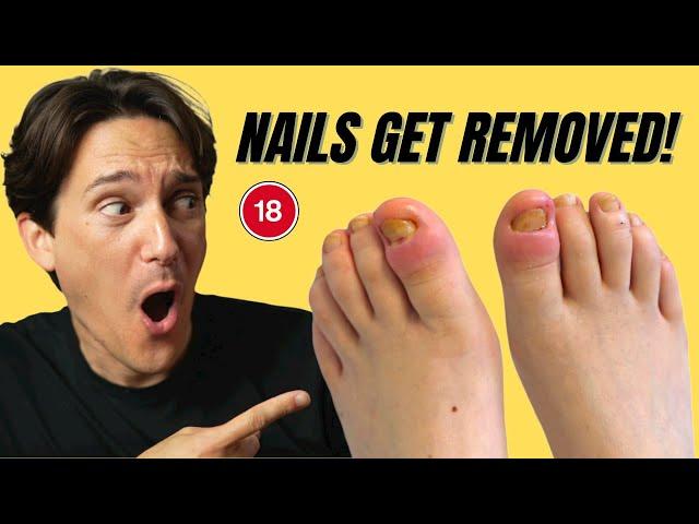 WATCH Painful Toenail Removal for Paronychia/Retronychia