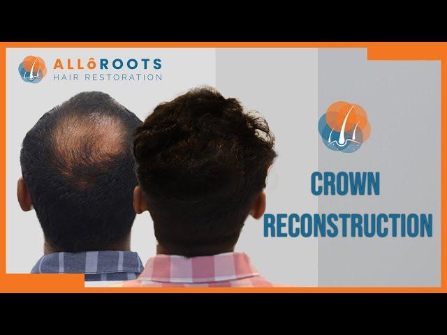 Crown Reconstruction | Hair Transplant by Dr Alok Sahoo | Patient Experience | Alloroots