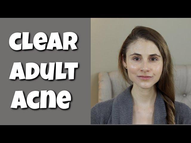 Adult acne: what you need to know to clear your skin| Dr Dray