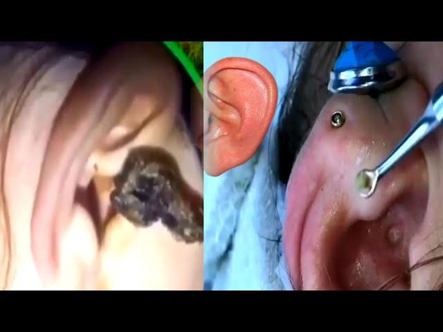 Ear Extractions! Blackhead Extractions| Satisfying Video Acne| ВЫДАВЛИВАНИЕ ЧЕРНЫХ ТОЧЕК в Ушах
