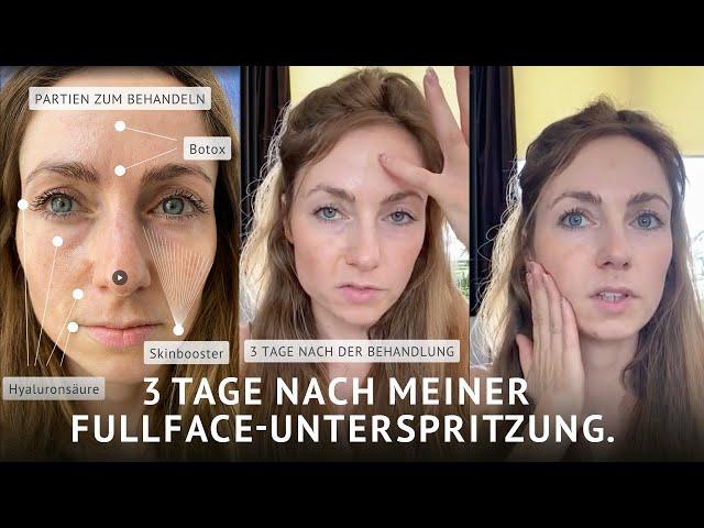 Teil 1: Meine erste Unterspritzung mit Hyaluronsäure und Botulinumtoxin. 3 Tage später.