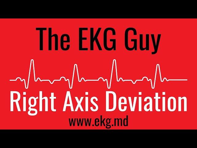 Right Axis Deviation on EKG / ECG l The EKG Guy - www.ekg.md