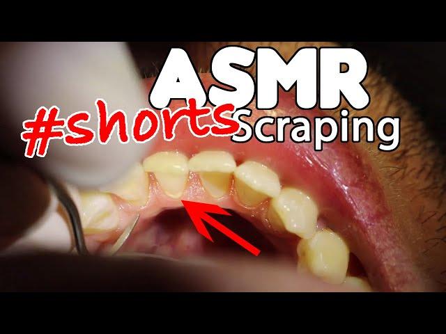 ASMR Dental Scraping Teeth #shorts #teethcleaning #plaqueremoval #plaque