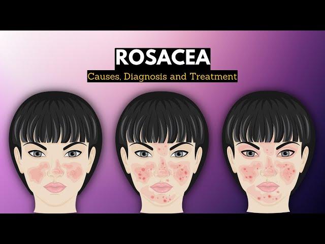 Rosacea, Causes, Signs and Symptoms, Diagnosis and Treatment.