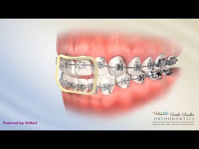 Elastics - Anterior Box - Orthodontic Treatment - Open Bite