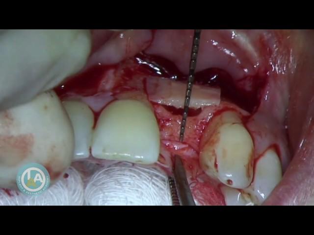 Bilateral Khoury Block - Dr Howard Gluckman