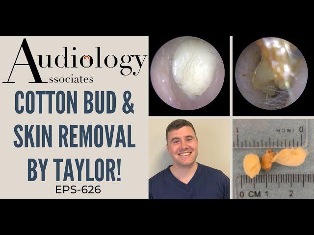 COTTON BUD & SKIN REMOVAL BY TAYLOR - EP626