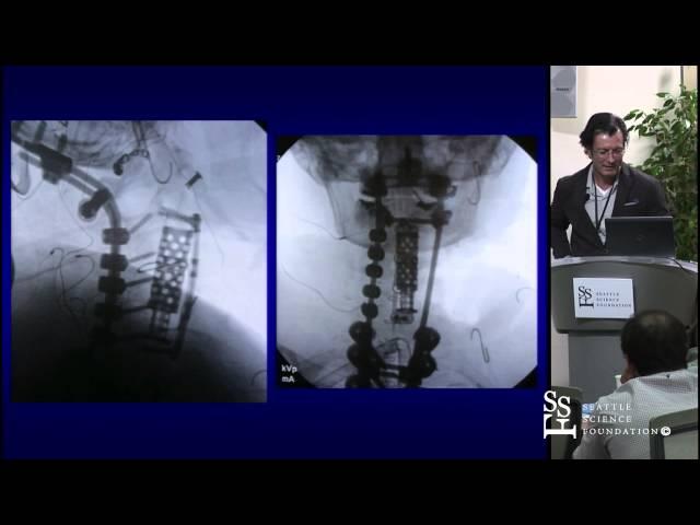 Spinal Tumors: Surgical Management & Complication Avoidance by Ehud Mendel, M.D.