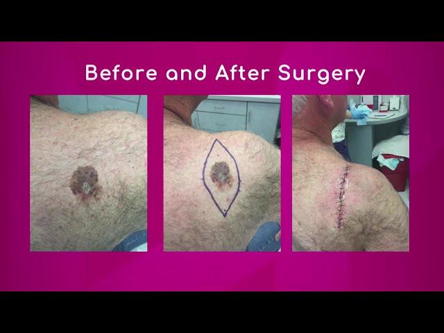 Surgery for Melanoma