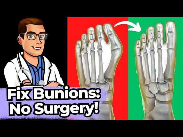 Bunion Home Cure [WOW] Stretches, Exercises & Correctors *NO Surgery*