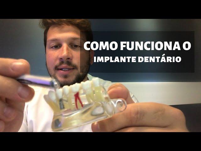 Como Funciona o Implante Dentário (objetivo) | Dr. Victor Hugo Almeida