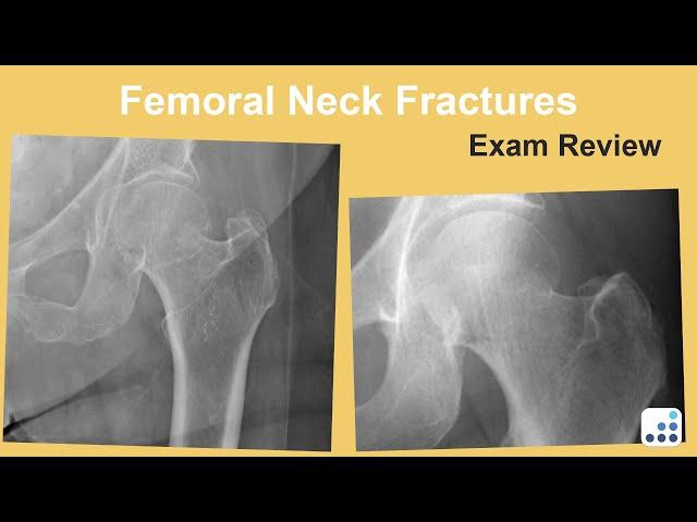 Femoral Neck Fractures Exam Review - Bohannon Mason, MD