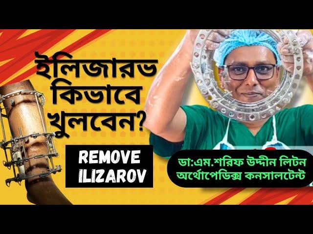 Removal of Ilizarov | ইলিজারভ কিভাবে খুলবেন | Ilizarov | Dr.M.Sharif Uddin Liton