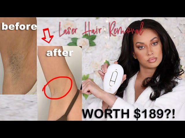 I tried IPL Laser Hair Removal! Is it worth it??? RoseSkinCo Lumi Results