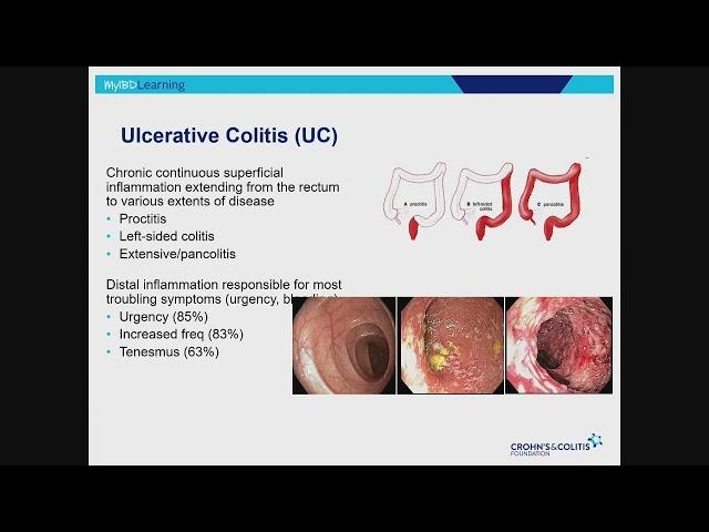 IBD 101: An Overview of Inflammatory Bowel Disease