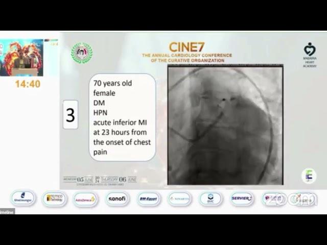 CINE7 Evidence behind deferred stenting of culprit  and staged stenting of non culprit in STEMI