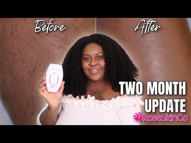 AT HOME LASER HAIR REMOVAL - 2 MONTH UPDATE RoseSkinCo