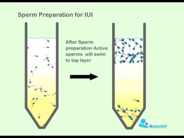 Sperm Preperation For IUI