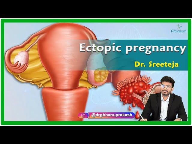 Ectopic Pregnancy : Etiology, Clinical features, Diagnosis, Treatment and Complications : Gynecology