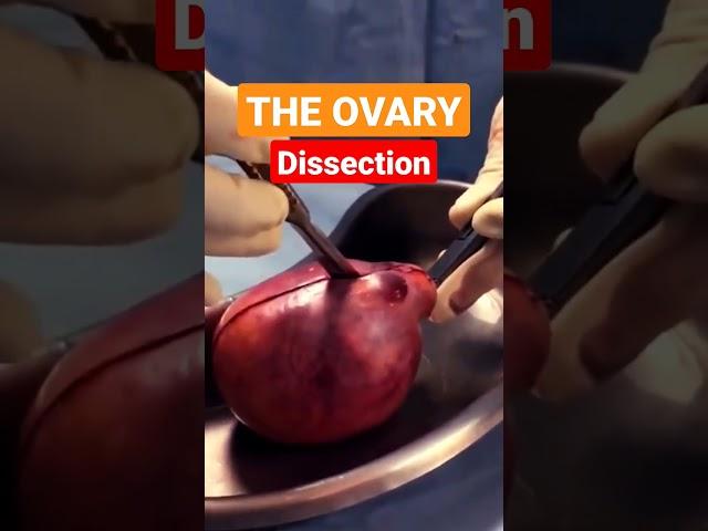 Dissection of Ovarian Teratoma