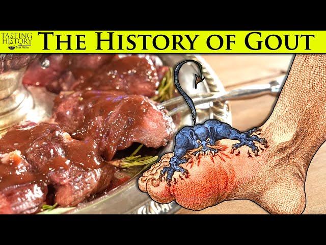 Gout - The Disease of Kings