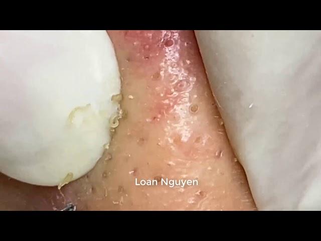 ACNE TREATMENT ON THE FACE | LOAN NGUYEN