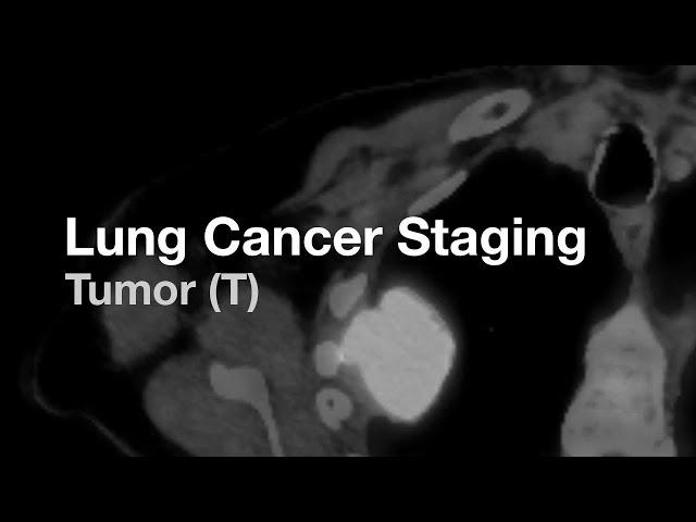 Lung Cancer Staging - Tumor (T)