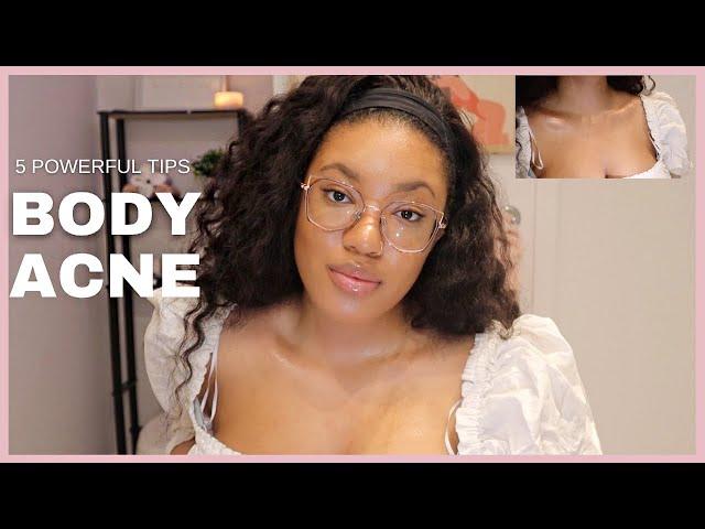 5 EFFECTIVE SKIN CARE TIPS TO GET RID OF BODY ACNE FAST & KEEP IT GONE FOR GOOD !!