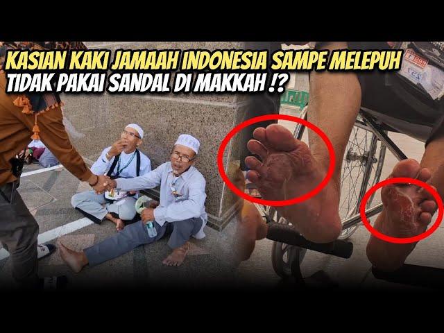 INILAH YANG TERJADI DENGAN JAMAAH HAJI INDONESIA KAKINYA MELEPUH PANAS