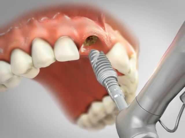 Implantes dentários Clínica Odontowicz