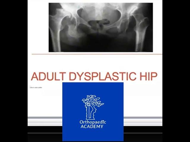 Adult Hip Dysplasia | Acetabular Protrusio - The FRCS Questions
