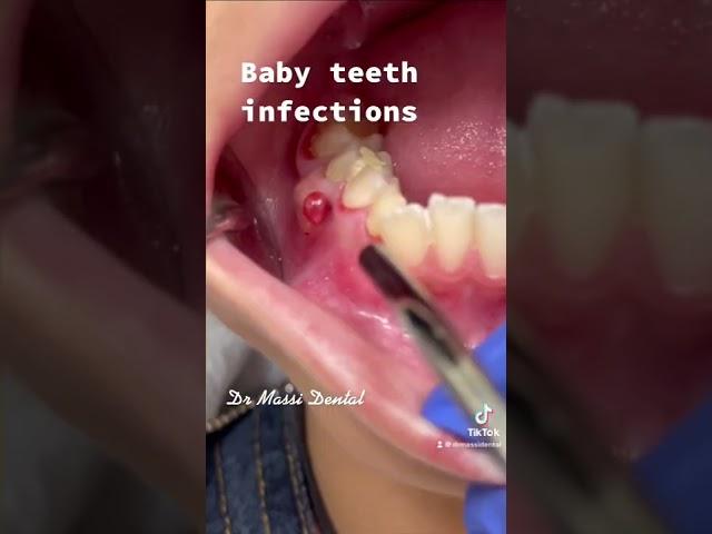 Dental Fistula, baby teeth infection #video #trending #tiktok #viral #shorts #youtubeshorts #shorts