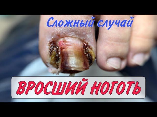 Как убрать вросший ноготь/ врос ноготь на ноге/ дикое мясо на пальце/ подолог Москва