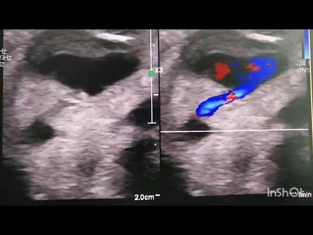 Heart shaped false aneurysm from the radial artery after coronary angiography