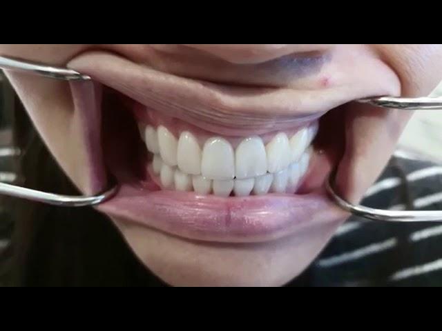 Smile Design by Dr Aleem, Non-cutting Porcelain Veneers and two crowns