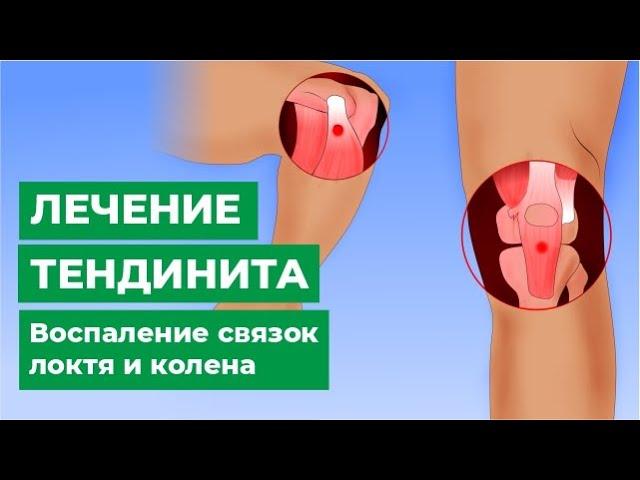 Лечение тендинита. Воспаление связок локтя и колена.