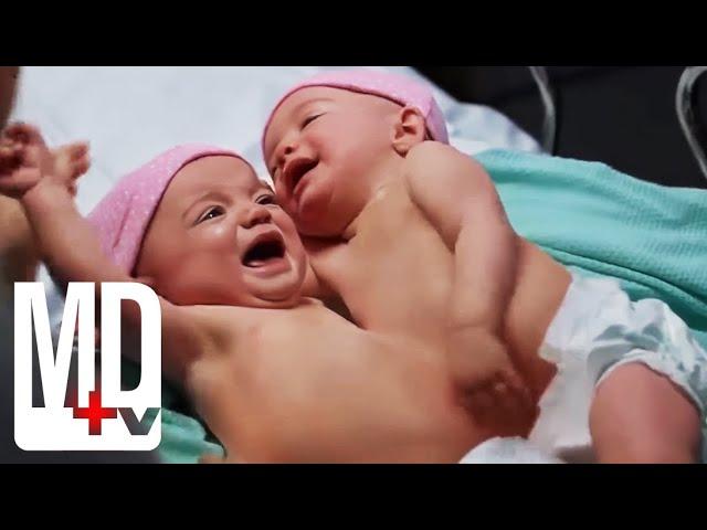 Trying to Save Both Conjoined Twins | Chicago Med | MD TV