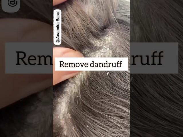 Remove Dandruff Just In 1 Wash#dandruff #haircare #hairfall #hairgrowth #viral #1m #short #shorts