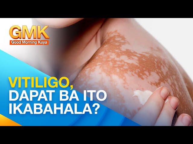 VITILIGO: Causes and Treatments Explained by Dermatologist | Usapang Pangkalusugan