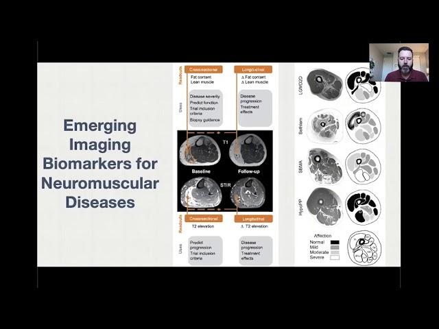 MRI Methods of Neuroimaging Research to improve diagnosis and understand disease progression