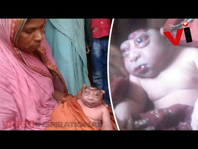 Baby Born With Extremely Rare Deformity Is Rejected By His Mum 'For Looking Like An Alien'