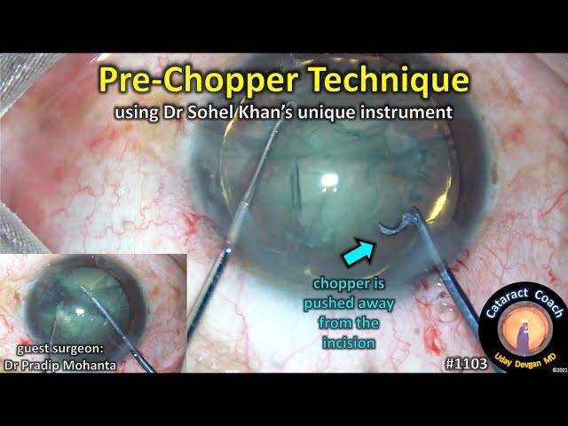 CataractCoach 1103: Pre-chopper Technique with Dr Pradip Mohanta