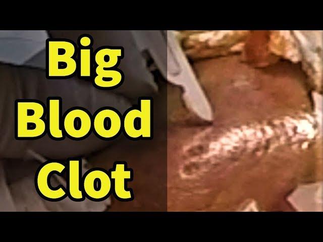 Big Blood Clot: Evacuation of Lower Leg Hematoma
